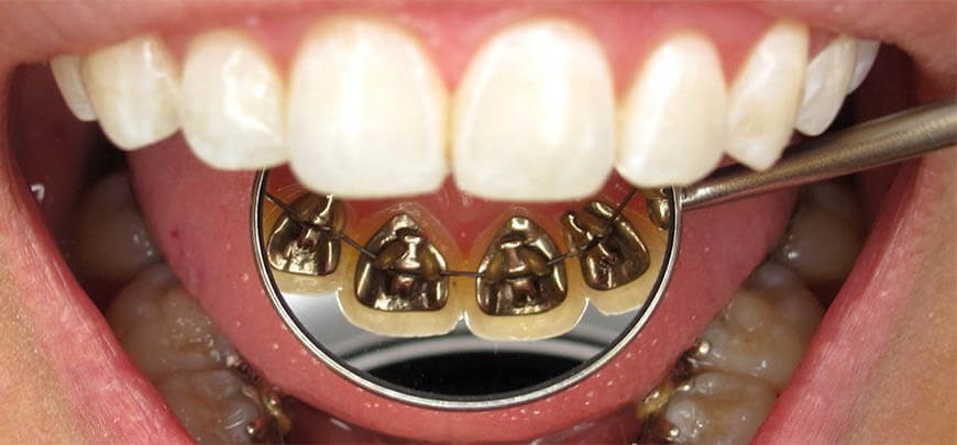 lingual ortodontik tedavi
