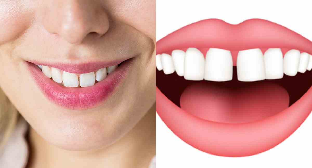 ayrık ön diş tedavi süreci
