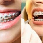 Post list-yeni 7 bursa ortodontist, bursa ortodonti, bursa ortodonti uzmanı, bursa diş teli tedavisi, bursa şeffaf plak tedavisi, bursa ortognatik cerrahi, bursa ortodonti fiyatları, bursa ortodonti yorumları, bursa ortodonti tavsiye, bursa çocuk ortodontisi, bursa yetişkin ortodontisi, bursa estetik ortodonti, bursa telsiz ortodonti, bursa sabit ortodonti, bursa ortodonti randevu,