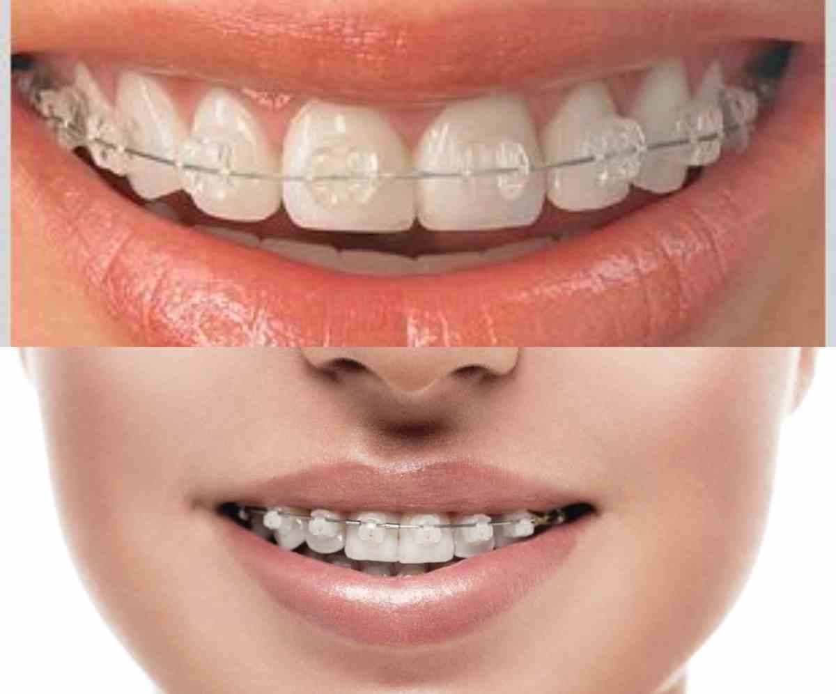 seramik diş teli tedavisi