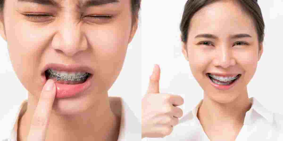 diş teli ağrısı nasıl geçer